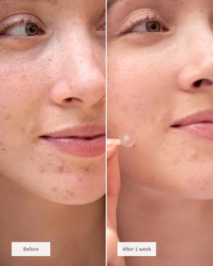 CLEARING SPOT PATCHES