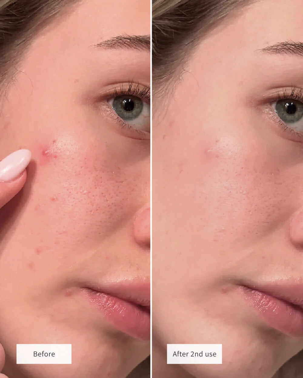 CLEARING SPOT PATCHES